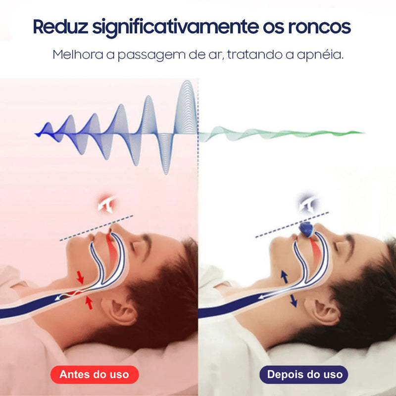 Dispositivo Eletrônico Mini-CPAP Anti-Roncos SleepGuardian®