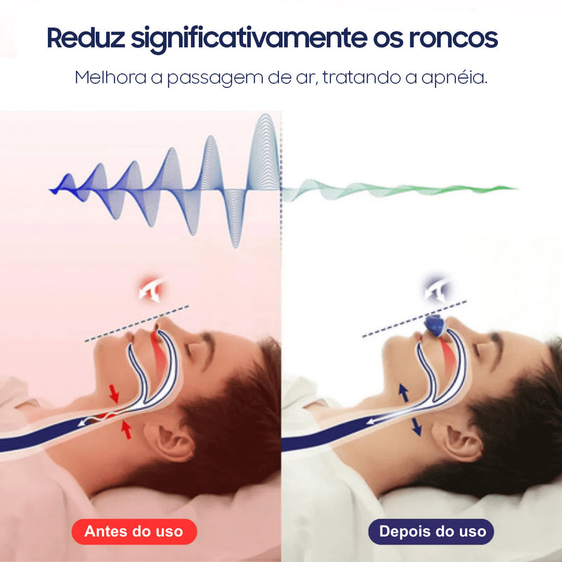 SLEEPGUARDIAN® - O PRIMEIRO DISPOSITIVO ELETRÔNICO MICRO-CPAP PRO® - SEM TUBO, SEM MÁSCARA E SEM FIOS